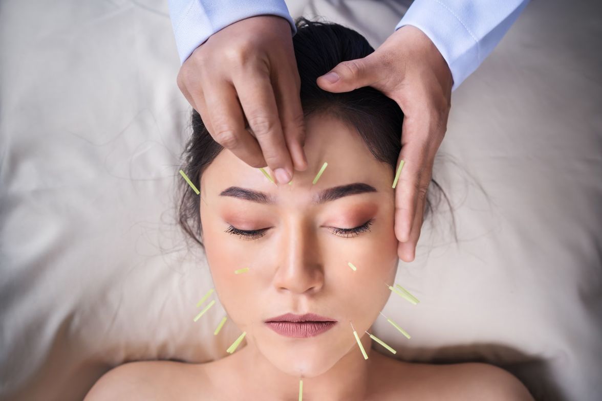 Acupuncture1AHC Wellness Clinic